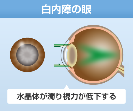 白内障の眼