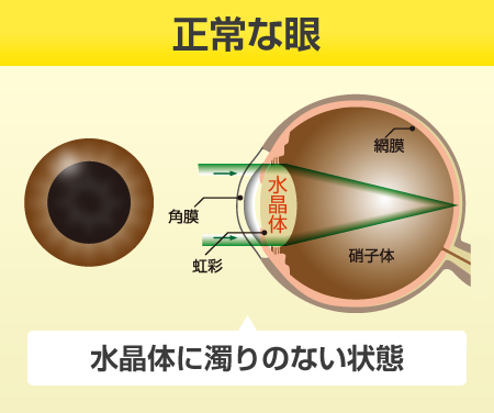 正常な眼